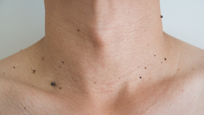 Skin Tag Removal Minneapolis St Paul Mn