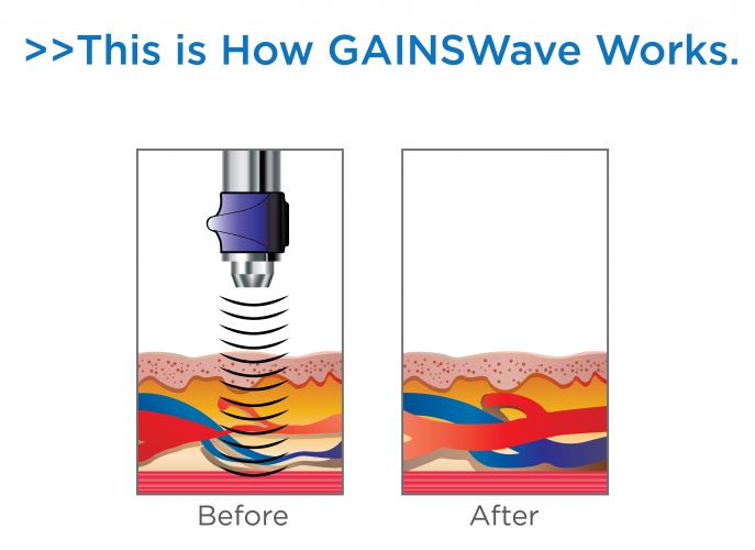 how GAINSWave works