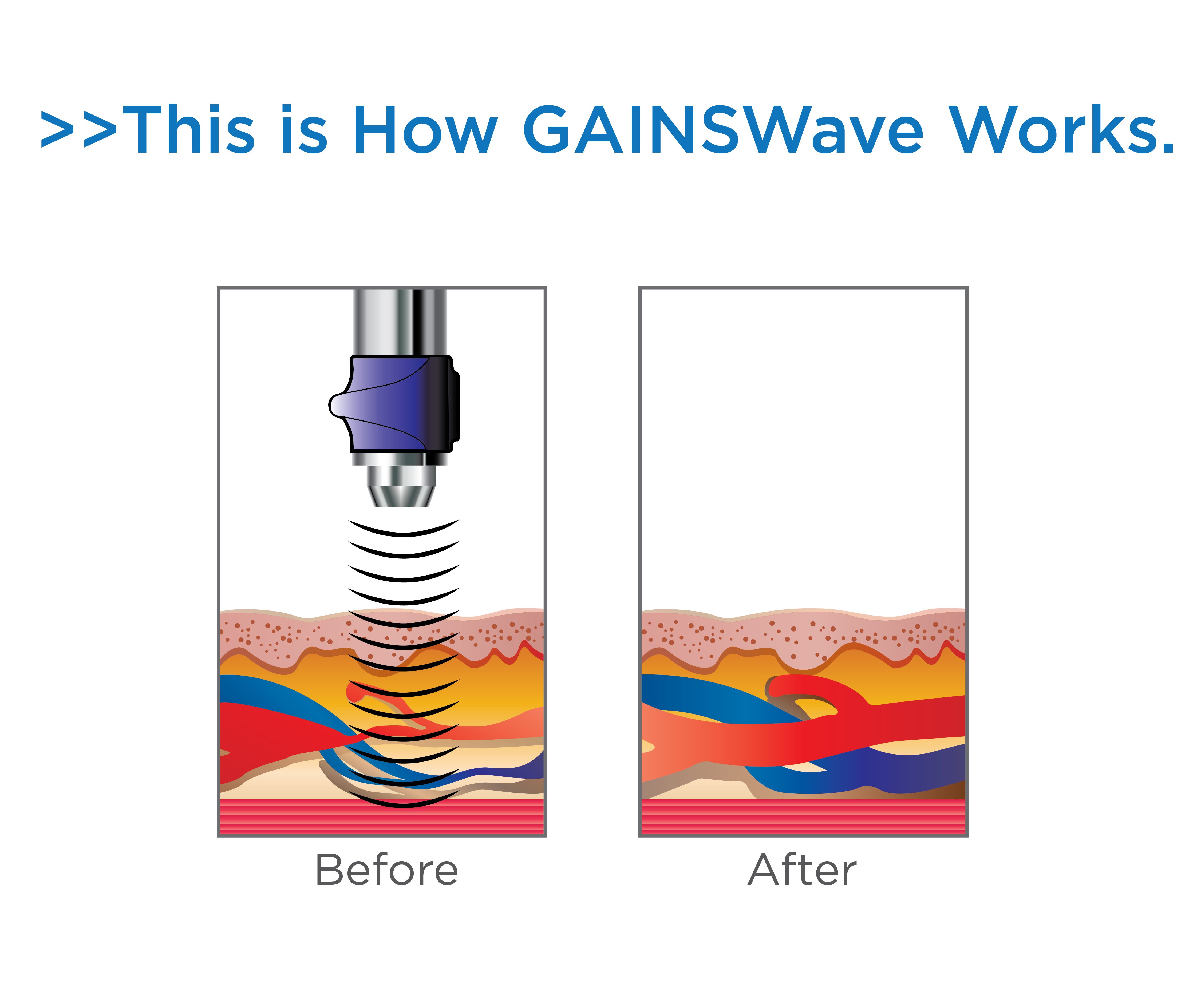 how GAINSWave works